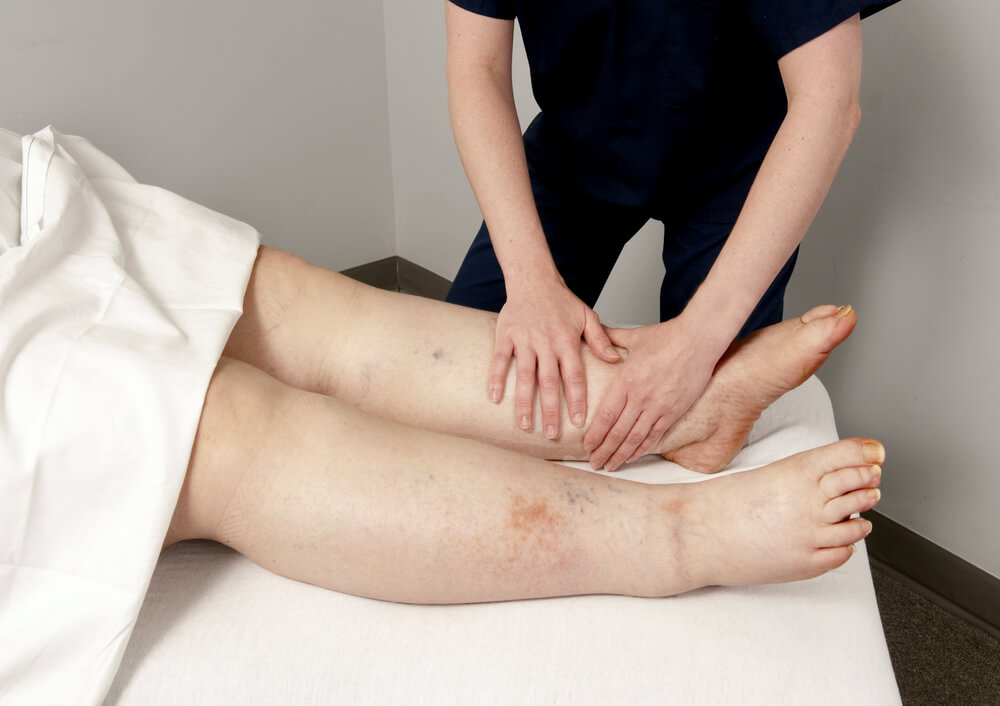 Lymphedema Physical Therapy