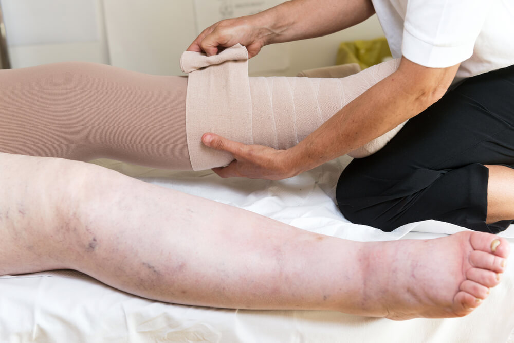 lymphedema therapy treatment options