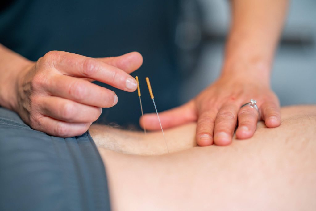 Dry Needling in Apache Junction, AZ AdobeStock 457665050 scaled 1 dry needling in apache junction, az